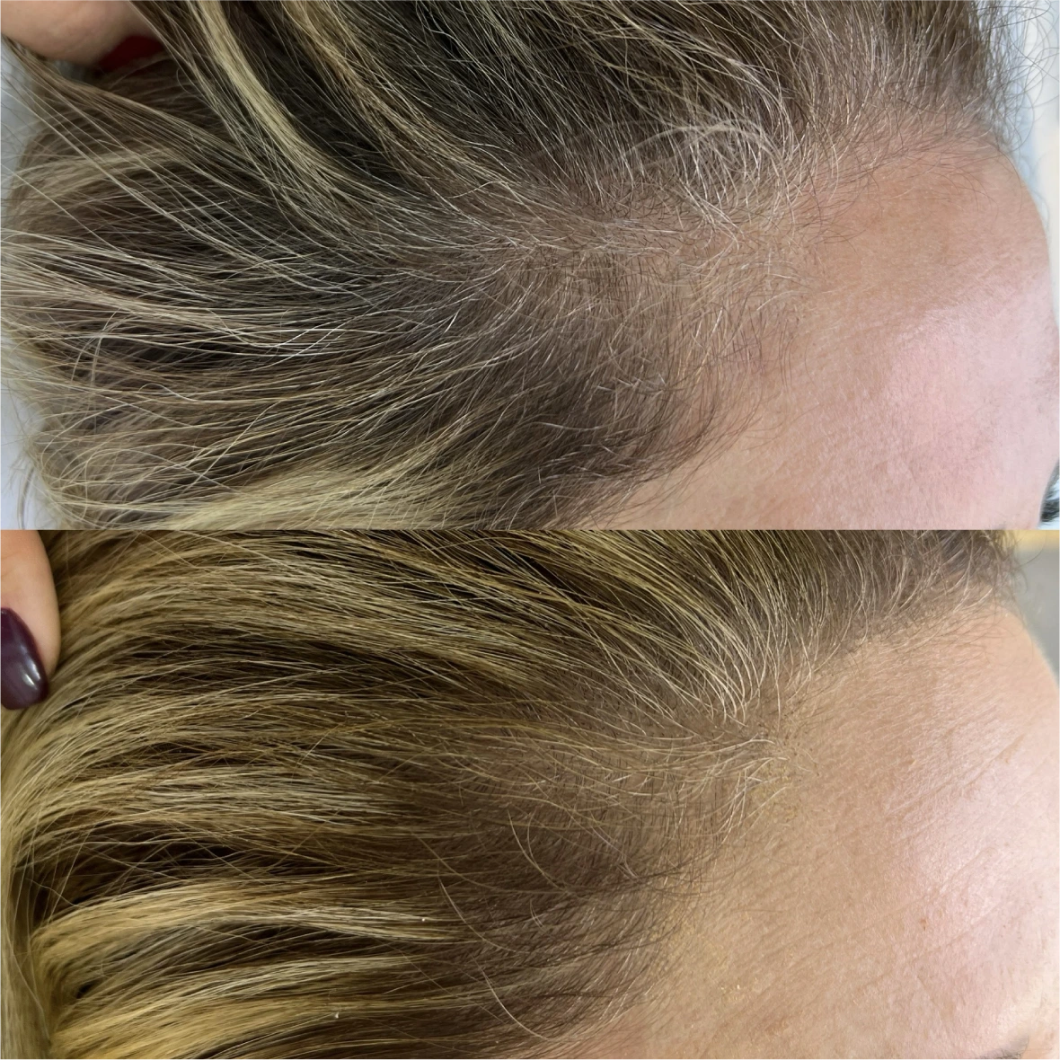 Antes e depois, Capilar, entradas, 65 dias de uso