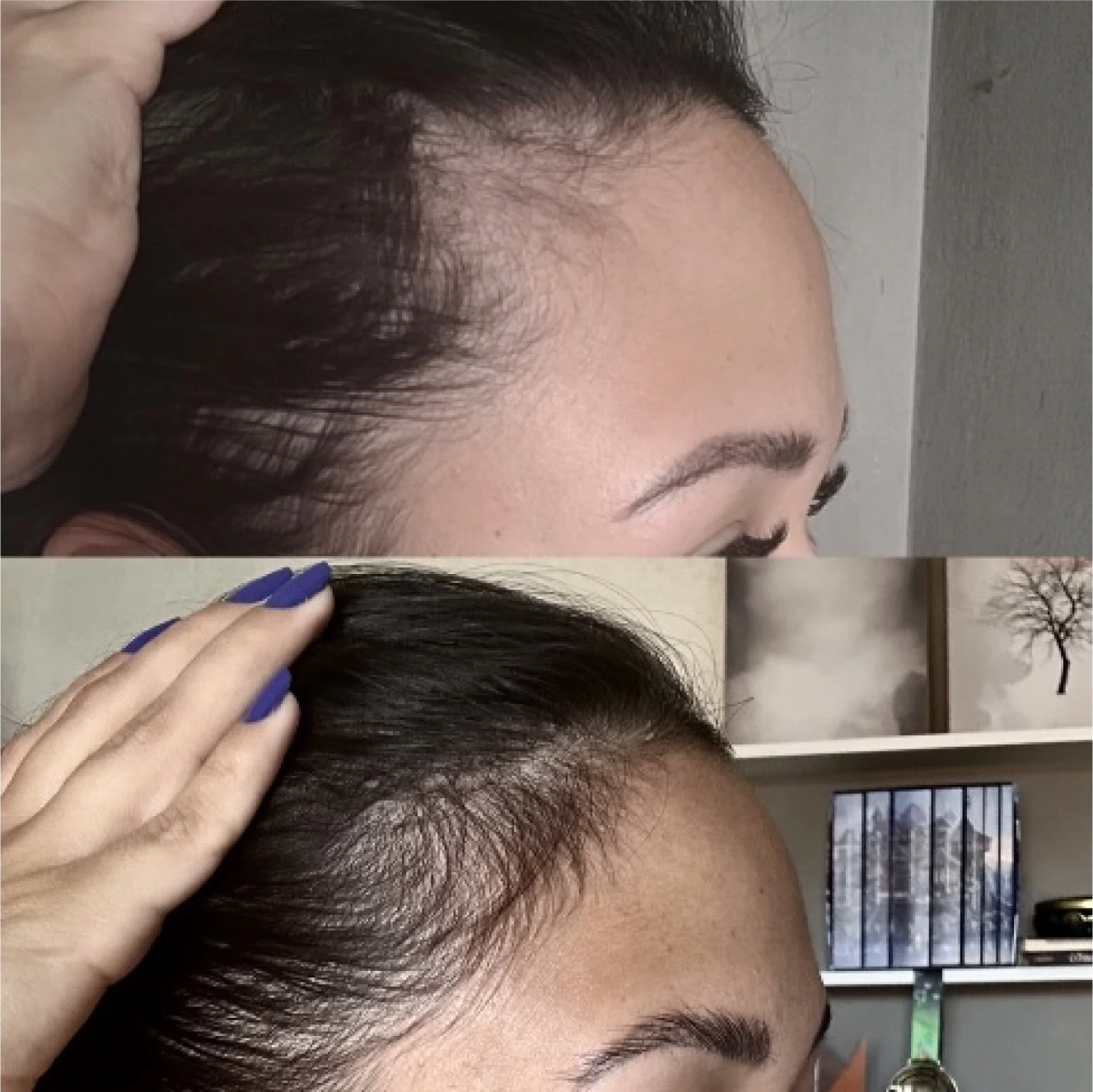 Antes e depois, Capilar, testa, 67 dias de uso