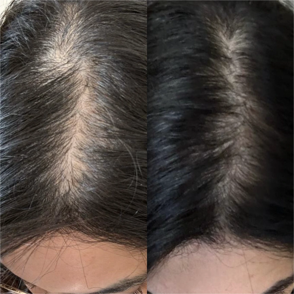Antes e depois, Capilar, coroa, 75 dias de uso