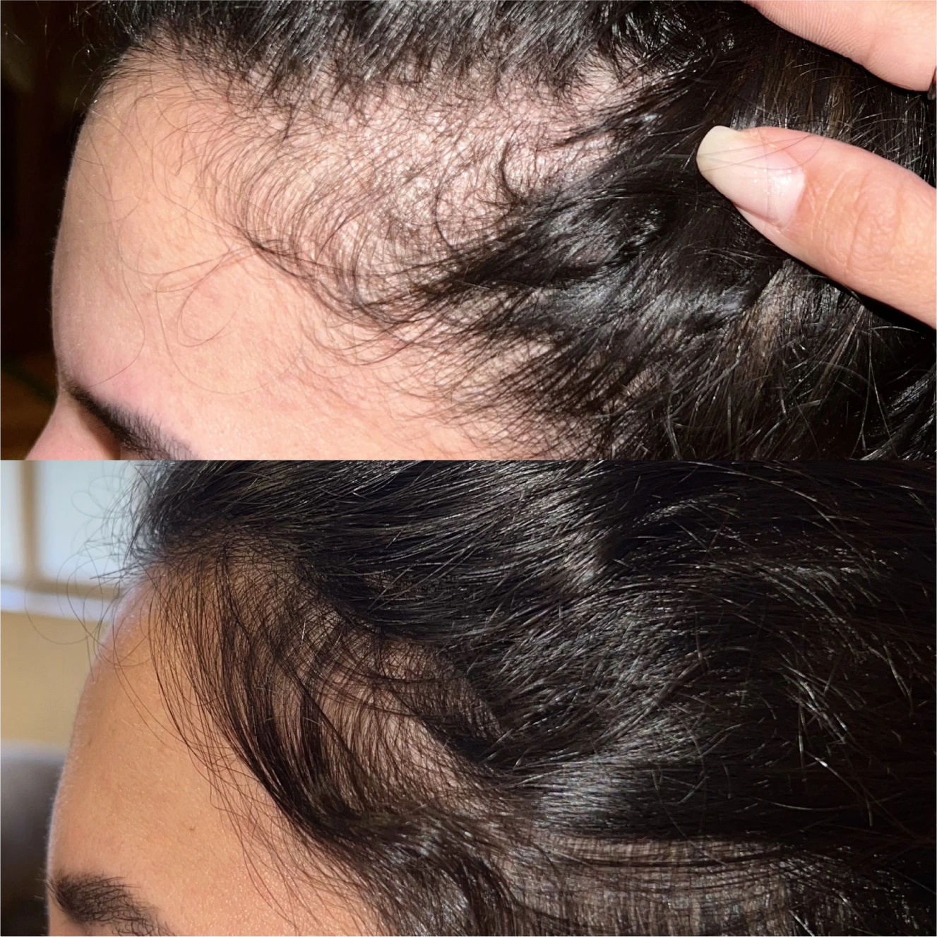 Antes e depois, Capilar, linha frontal, 90 dias de uso