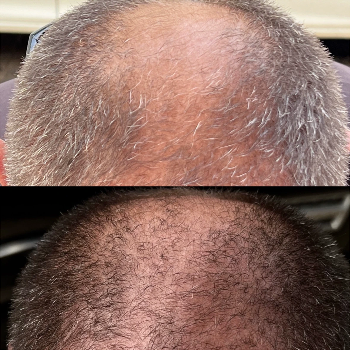 Antes e depois masculino, Coroa masculina, 28 dias