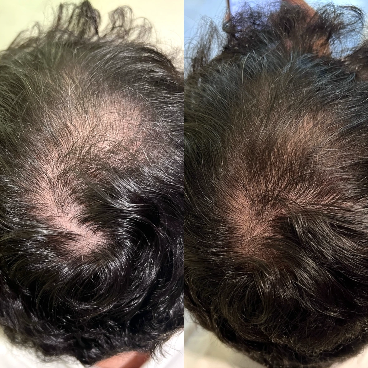 Antes e depois masculino, Topo e entradas, 65 dias