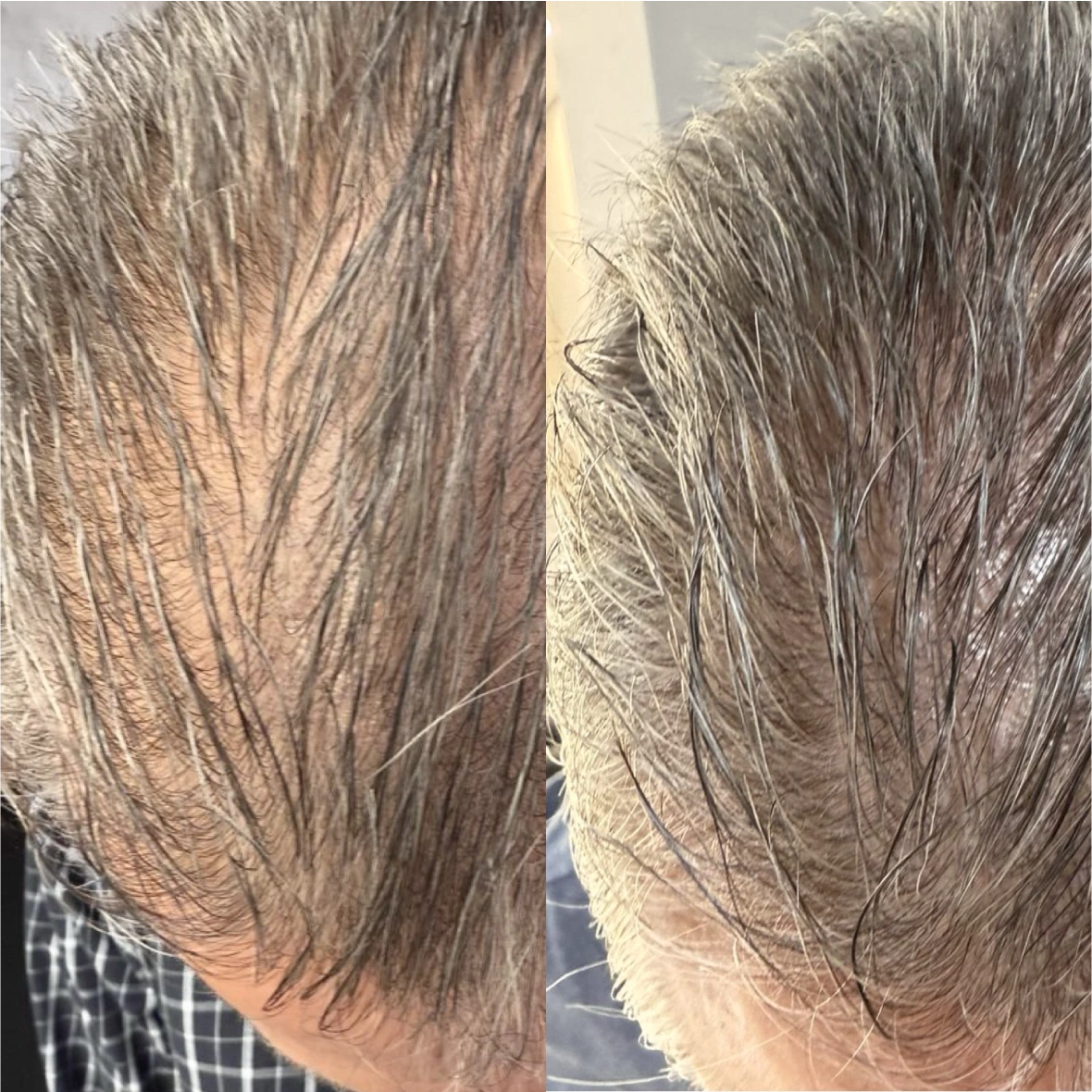 Antes e depois masculino, Linha frontal, 70 dias